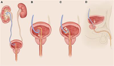 Transurethral Retrograde Fishing the Double J Urethral Stent: A Tertiary Children Hospital's Experience With a New Technical Strategy